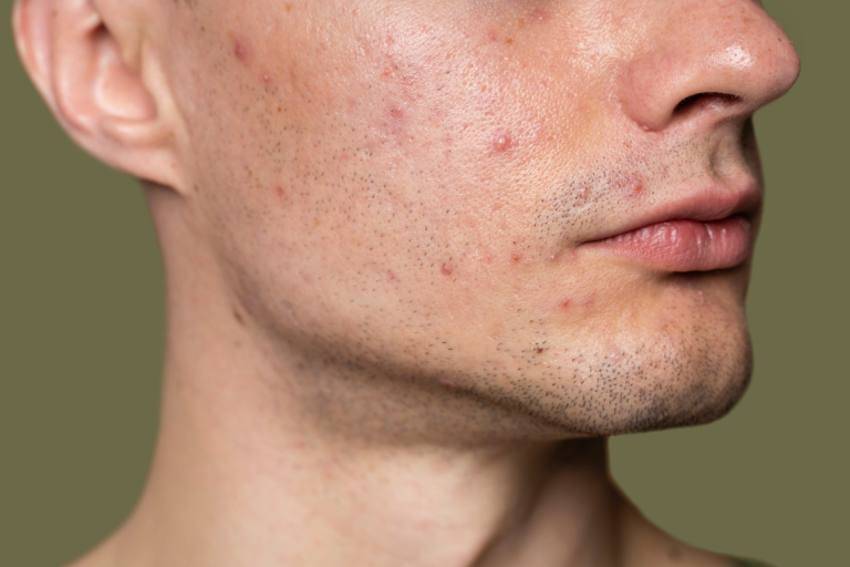5 Proven Acne Treatments Recommended by Top Montreal Dermatologists
